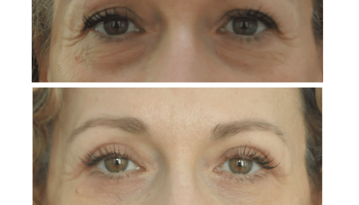 avant/après blépharoplastie