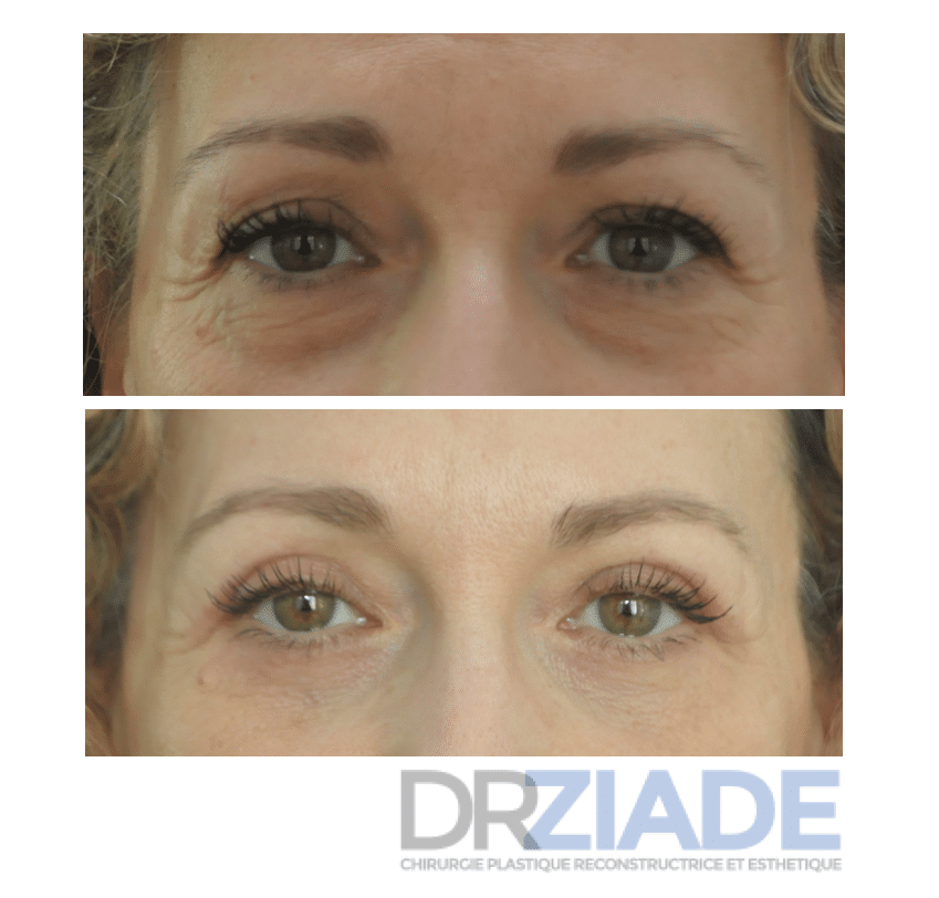 avant/après blépharoplastie