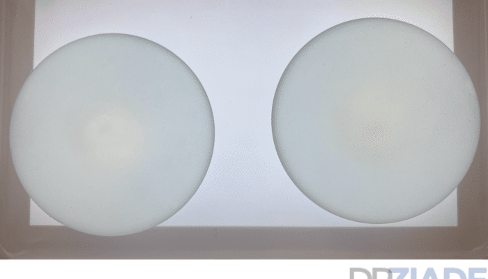 aplatissement implants mammaire
