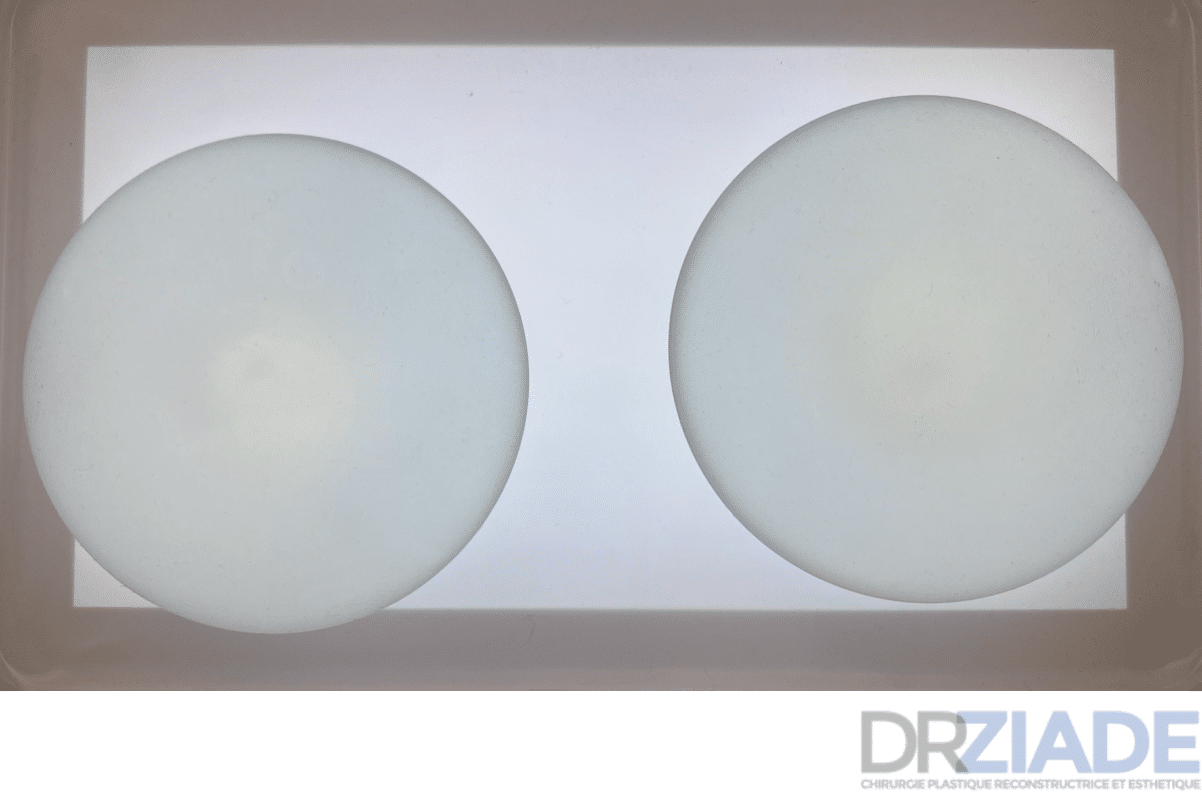 aplatissement implants mammaire