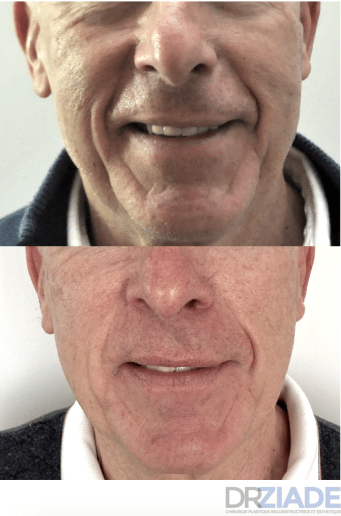 Intervention pour homme lifting cervico-facial