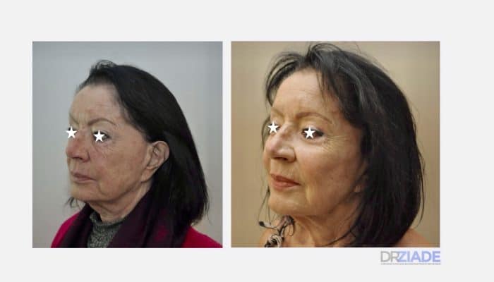 Avant - Après Lipofilling du visage